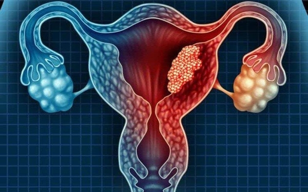 TRẢ BÀI – Ung thư buồng trứng: Người phụ nữ qua đời sau 8 ngày được chuẩn đoán mắc bệnh