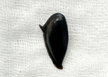 Nữ bệnh nhân gặp nạn nguy kịch sau khi ăn hồng xiêm